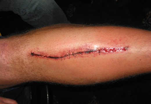 Harveys leg after stitching