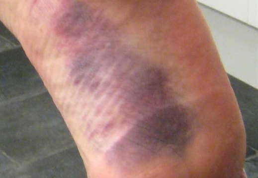 Bruise obtained after falling off 'Tear' SouthWest Buttress