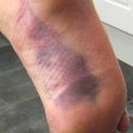 Bruise obtained after falling off 'Tear' SouthWest Buttress