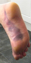 Bruise obtained after falling off 'Tear' SouthWest Buttress